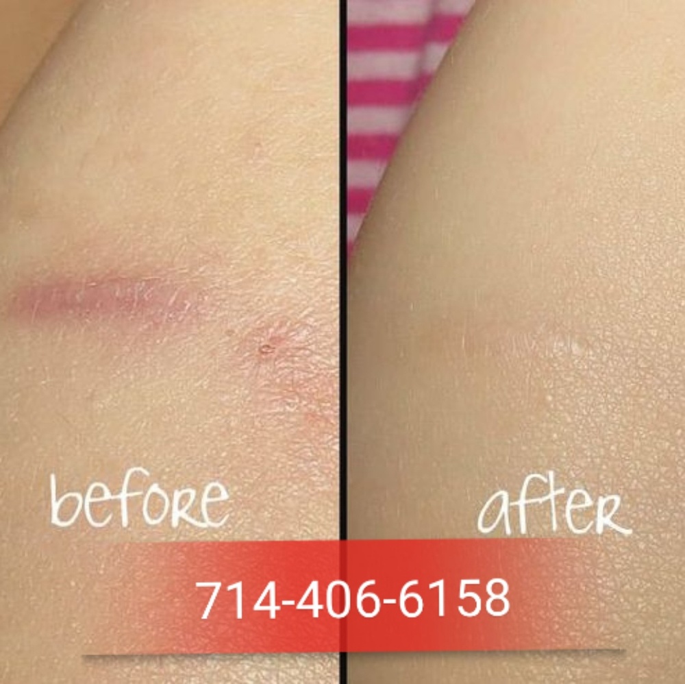 Stretch Mark - Dark Spot - Scars Removed